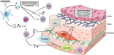 Current developments in the diagnosis and treatment of giant cell arteritis